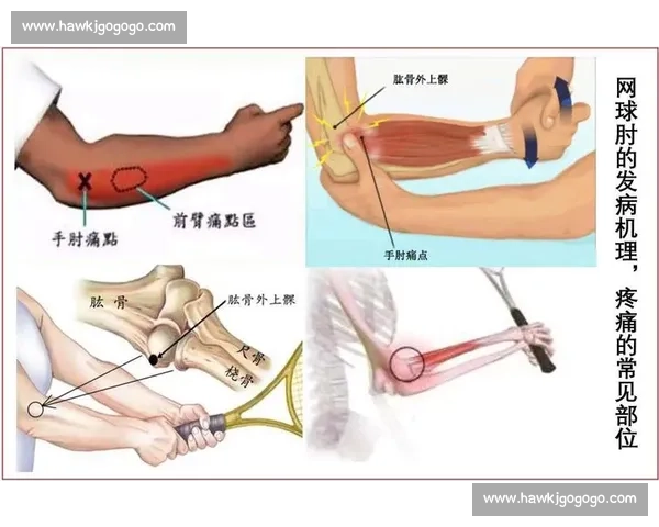 运动损伤预防与康复策略研究:从运动员到普通人群的有效应对方法 运动损伤预防与康复策略研究:从运动员到普通人群的有效应对方法